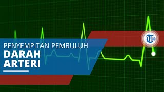 Aterosklerosis, Penyempitan Pembuluh Darah Arteri akibat Penumpukan Plak di Dinding Pembuluh Darah