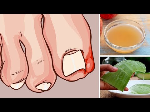 Spurge laban halamang-singaw sa kanyang mga paa Mabisang lunas para sa kuko halamang-singaw sa mga kamay review