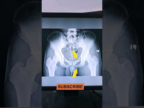 Fracture Hip Bone Pubis #shorts #xray