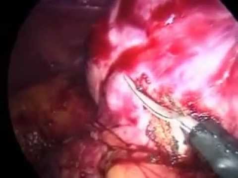 Calcificazioni ehopriznaki della prostata Immagine della prostata