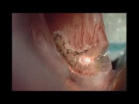 MCO 25plus – Applications in gynecology