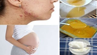 Natural Acne Treatment During Pregnancy - Remedies One