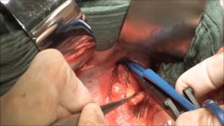 marClamp® Cut IQ and maXium® | Paraaortic lymph node dissection