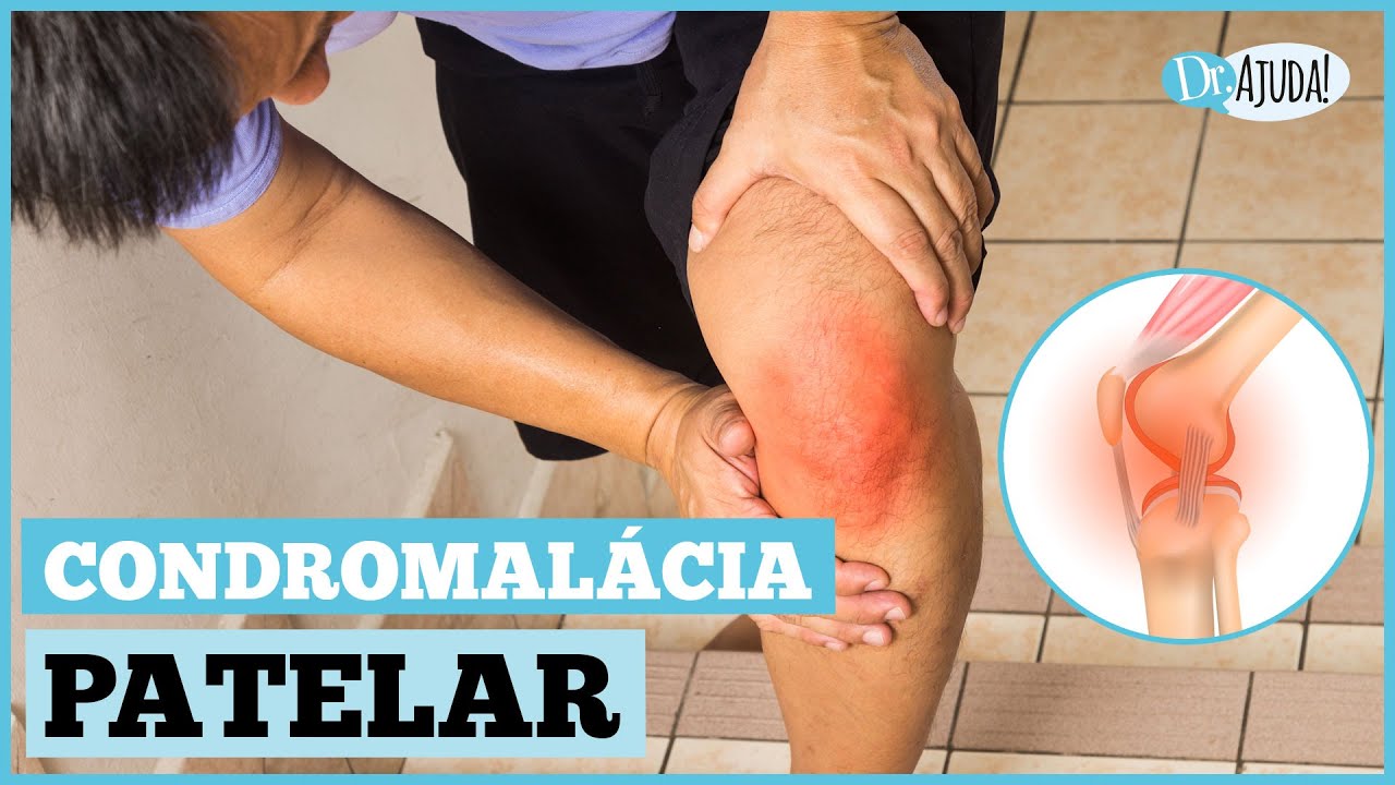 CONDROMALÁCIA PATELAR: O QUE É, CAUSAS, SINTOMAS, DIAGNÓSTICO E TRATAMENTO