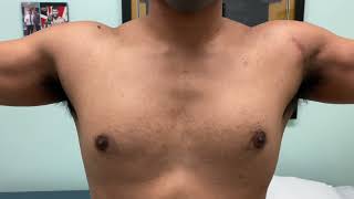 PEC MAJOR TEAR repair 3 months after surgery: The MoraPecFlexFix Technique