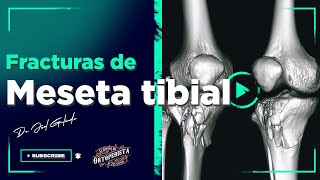 Fracturas de meseta tibial