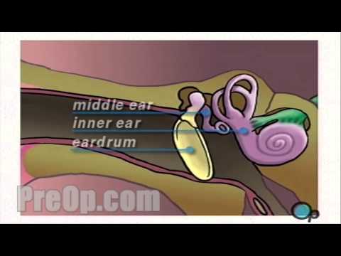 Myringotomie Einsetzen eines Schlauchs Operation PreOp® Patienteneinbindung und -aufklärung