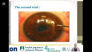 Difficult Femtolaser Cornea Cases