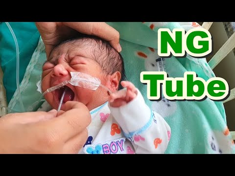 Infant Feeding Tube