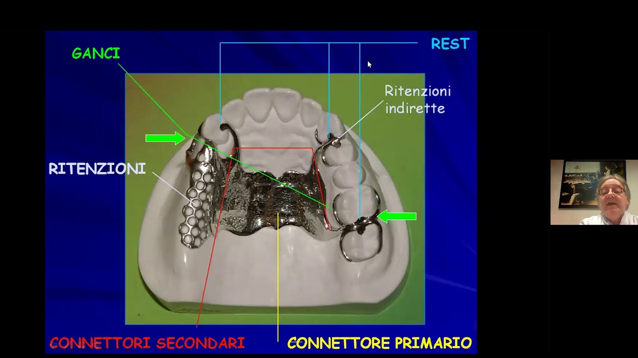 La protesi parziale ad appoggio muco-dentale
