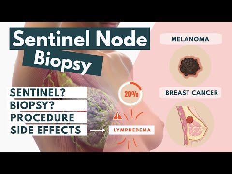Sentinel Lymph Node Biopsy | Procedure & Side-effects | Visual Explanation