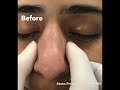 Wide Nose Closed Atraumatic Rhinoplasty
