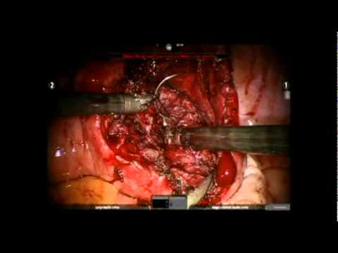 Robotic Myomectomy of Very Large Uterine Fibroids