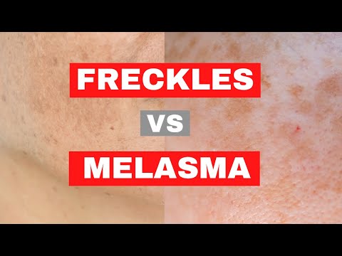WHAT IS THE DIFFERENCE BETWEEN FRECKLES AND MELASMA?