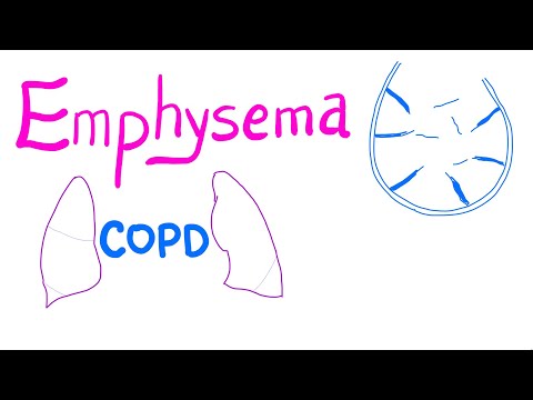 Emphysema - COPD - Pulmonary Medicine