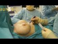 Removal and Replacement of PIP Implants - Very Severe Double Rupture