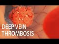 Venous Thromboembolism Deep Vein Thrombosis DVT Medical Animation