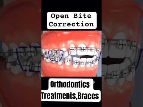 Open Bite Correction by Braces