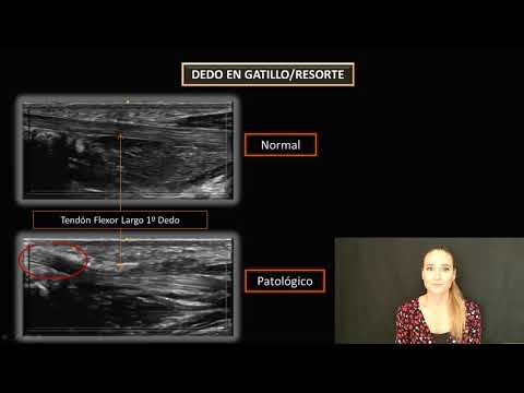 Dedo en gatillo / resorte - Ecografía con Ana de Groot