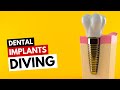 Dental Implants and Diving
