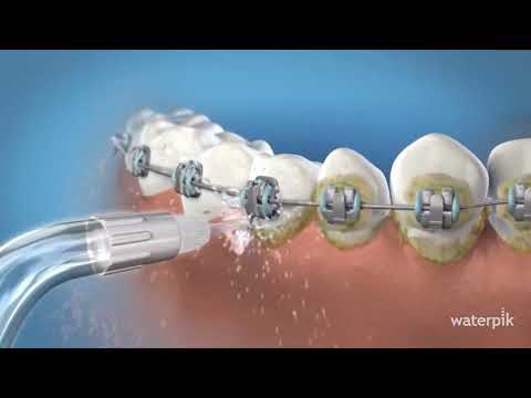 Miniatura del vídeo: cómo limpiar brackets paso a paso con irrigador