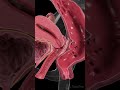 Endometriosis Beyond The Uterus 3D Animation