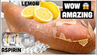 How to REMOVE CALLUSES AND CORNS from your feet organically using ASPIRIN