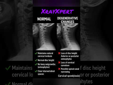 🦴 Cervical Spine – Normal vs Degenerative Changes🔍 X-ray Comparison #medicalimaging #xrayxpert #cxr
