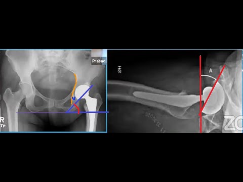 Acetabular Component Position in Total Hip Replacement