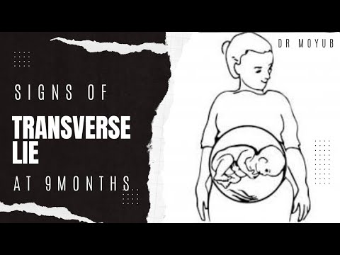 Signs of Transverse Lie at 9 Months. #pregnancy #pregnant
