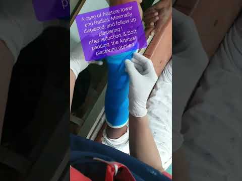 Fracture Lower end Radius | Closed reduction | Fiberglass plastering | Adamya hospital videos