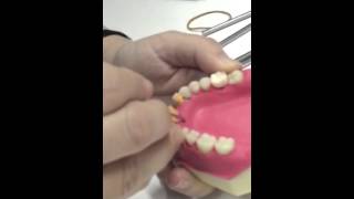 Skeling Penghalusan Akar (Scaling and Root Planning)