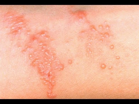 สิ่งยั่วยุกลาก Neurodermatitis โคลน