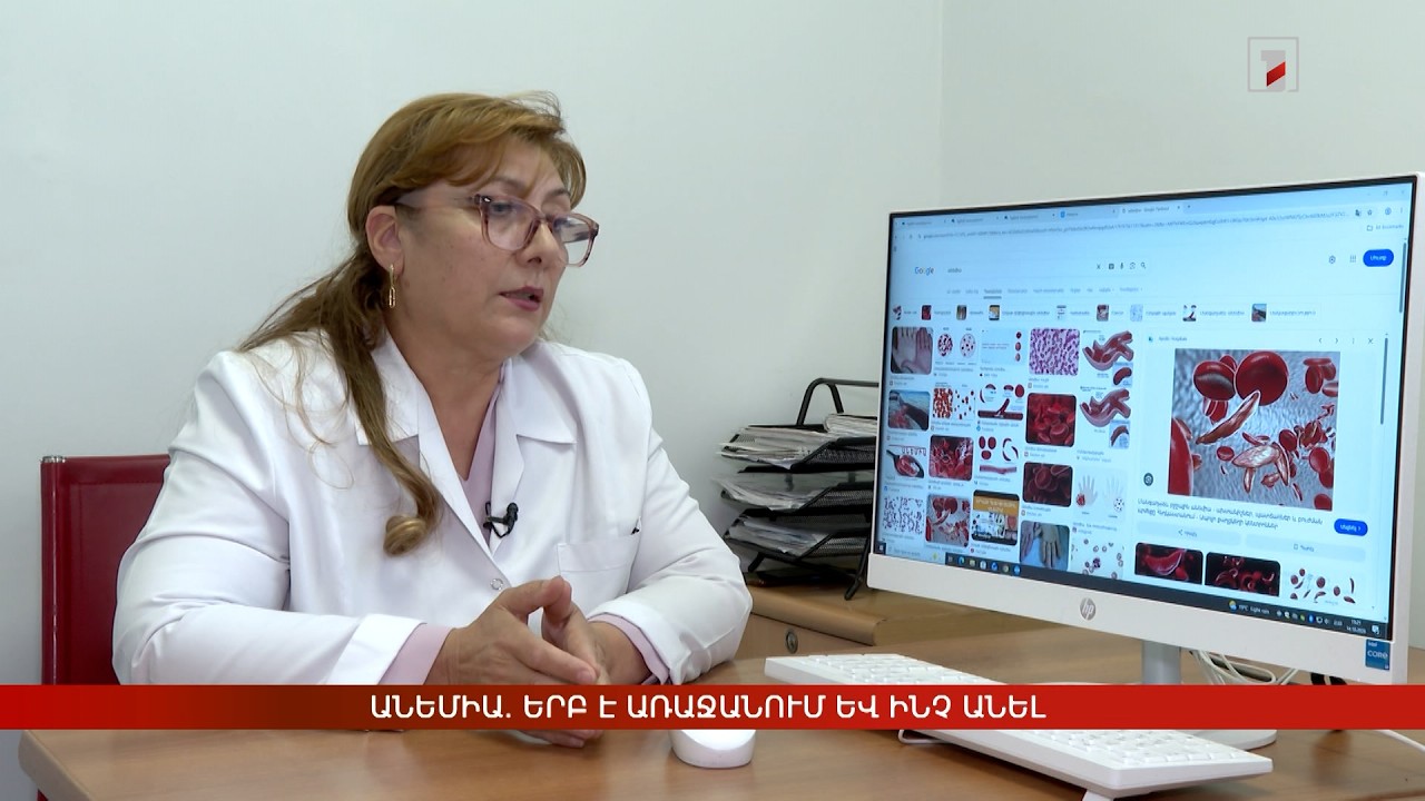 Անեմիա. երբ է առաջանում և ինչ անել