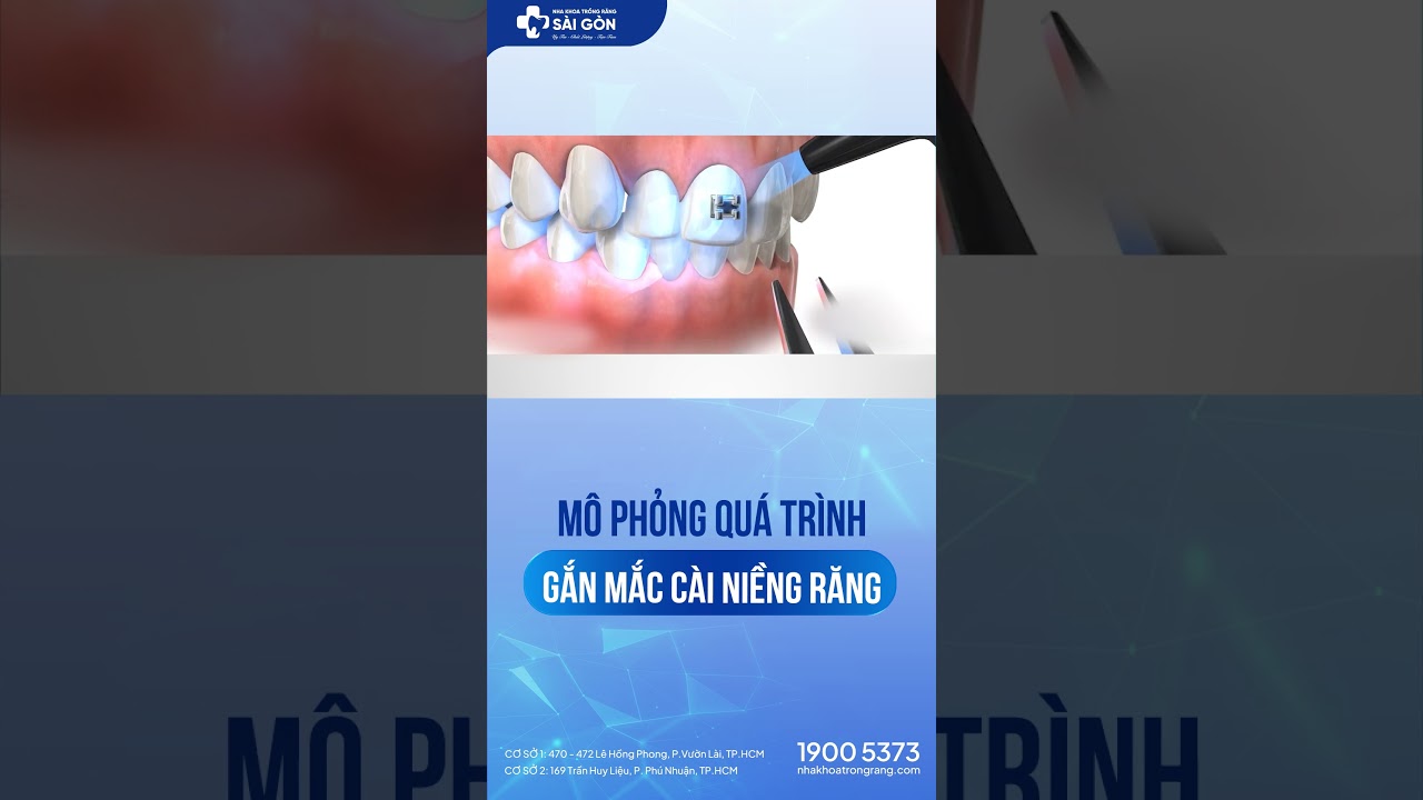Mô Phỏng Quá Trình Gắn Mắc Cài | Nha Khoa Trồng Răng Sài Gòn  #nhakhoatrongrangsaigon #niengrang