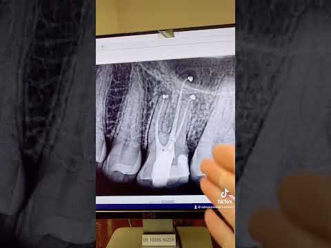 Root canal therapy of a calcified tooth #14 in one visit.