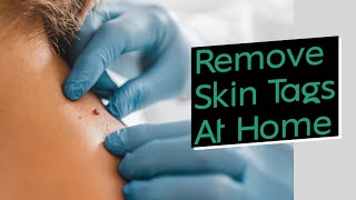 How to Quickly and Easily Remove Skin Tags at Home (Using Things You Already Own)