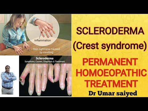 download lagu mp3 mp4 Scleroderma Cure In Homeopathy, download lagu Scleroderma Cure In Homeopathy gratis, unduh video klip Scleroderma Cure In Homeopathy
