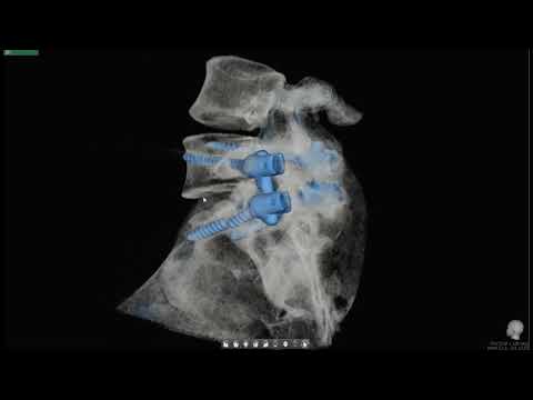 NewTom 7G - Lendewirbelsäule - Spondylolisthese - OP - defekte Schrauben im Kreuzbein
