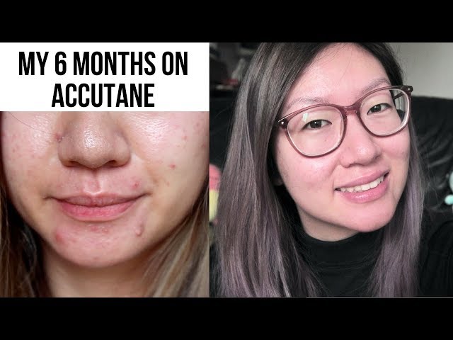 imputence accutane