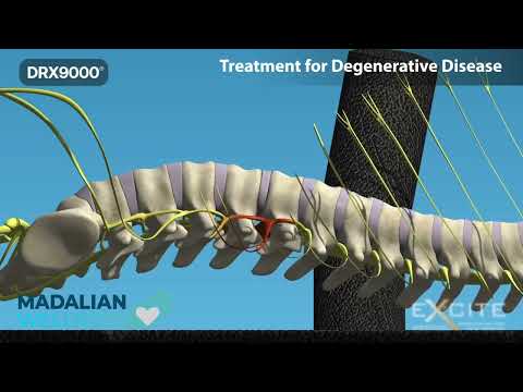Dr. Madalian discusses DRX9000 spinal decompression for back, neck, and sciatica pain