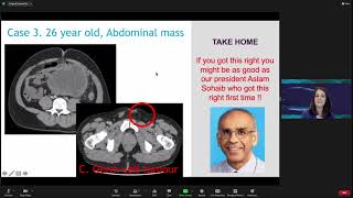 Extra-visceral soft tissue masses in the retroperitoneum and abdomen by Prof. Christina Messiou