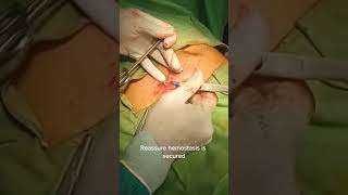 Open Appendectomy. Step by step guide