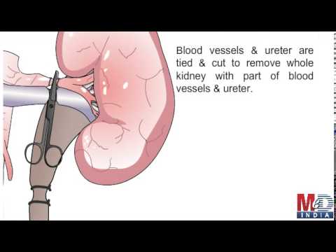 Nephrectomy - Types, Risks & Complications
