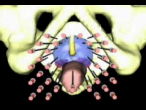 dopo radioterapia prostata hematuria icd 10