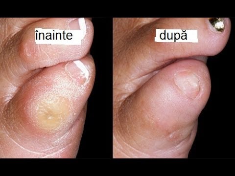 Tratament articular de lingonberry