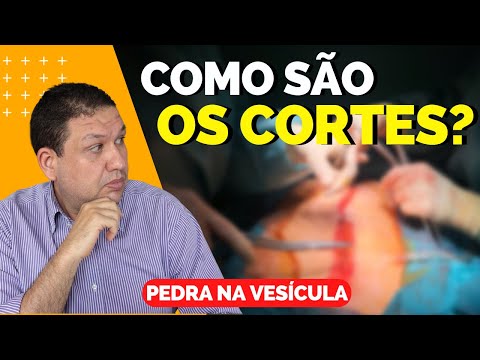 [ATENÇÃO] Cirurgia de PEDRA NA VESÍCULA. Como é feita as incisões da cirurgia de colecistectomia.