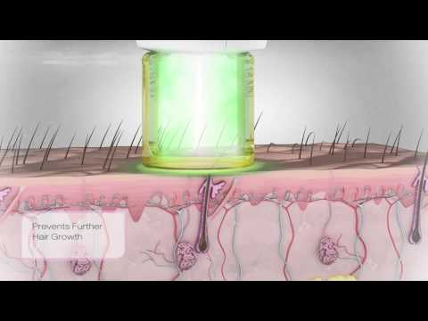 Gentle Hair Removal Treatment