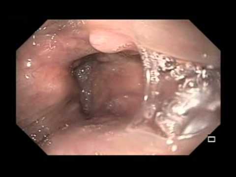 Epigloctic Cystic Tumors and Vascular Ectasias of the Epiglottis