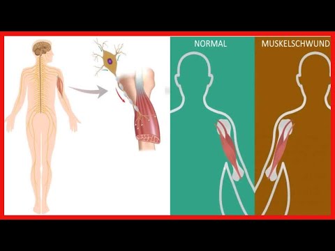 Neuromuskuläre Erkrankungen: Wissenswertes